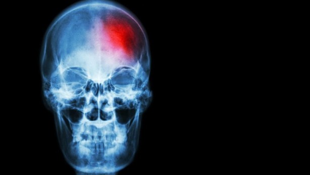 İnmenin 5 belirtisine dikkat!