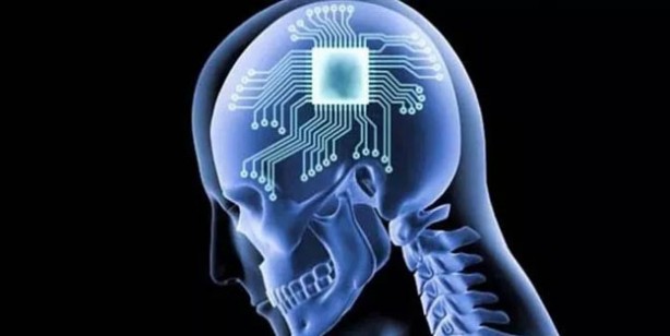 Foto - İnsan beynine ilk defa çip yerleştirdiler