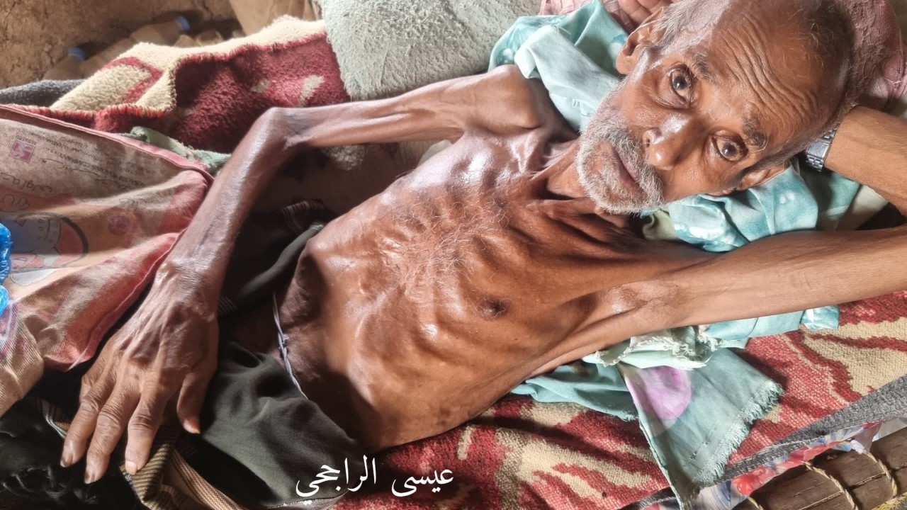 Foto - İnsani trajedinin yaşandığı Yemen'de açlıktan ölümler başladı!