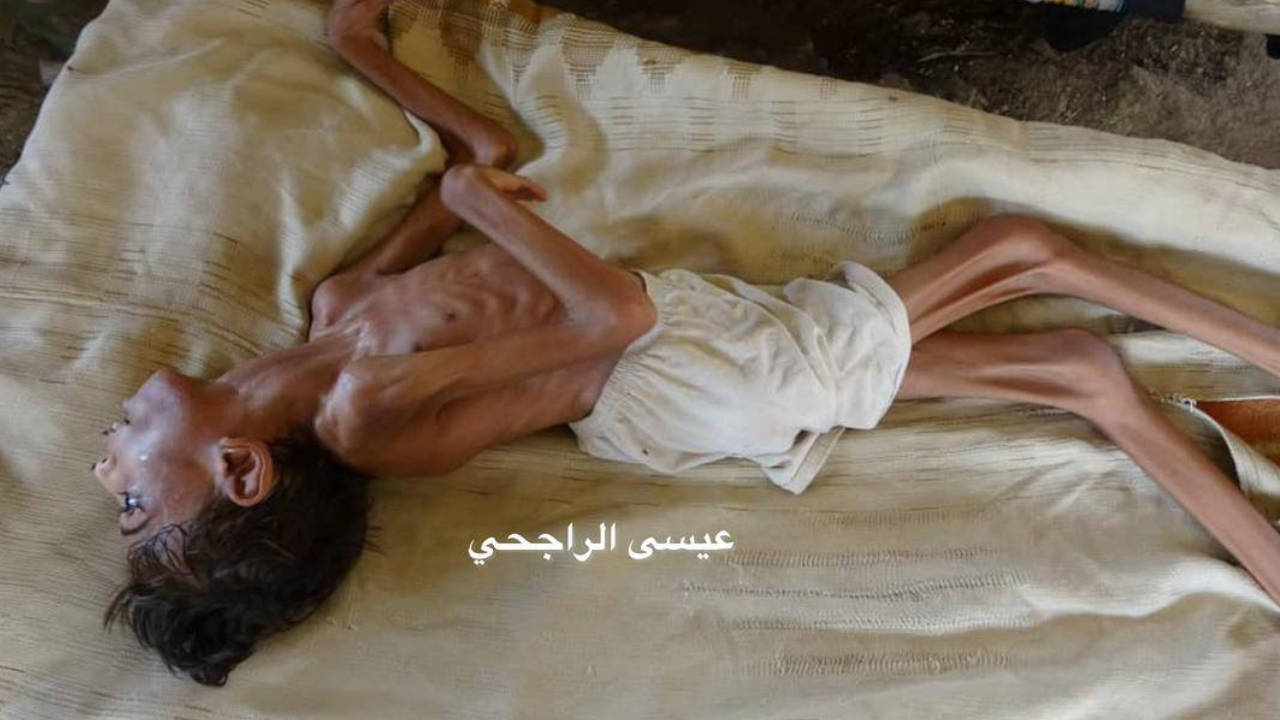İnsani trajedinin yaşandığı Yemen'de açlıktan ölümler başladı!