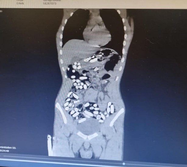Foto - Böyle uyuşturucu kaçakçılığı görülmedi! Doktorlar şaşkın