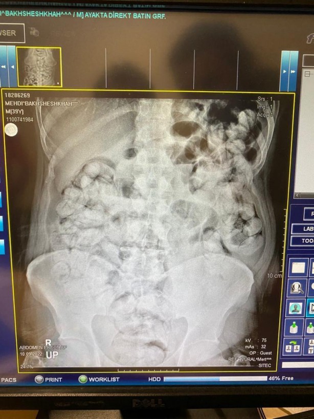 Foto - Böyle uyuşturucu kaçakçılığı görülmedi! Doktorlar şaşkın