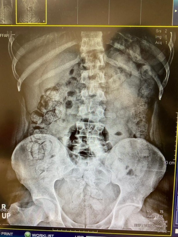 Foto - Böyle uyuşturucu kaçakçılığı görülmedi! Doktorlar şaşkın
