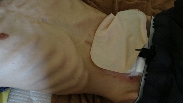 Foto - İş kazası geçirdi 40 kiloya düştü! Suriyeli Muhammed yardım bekliyor