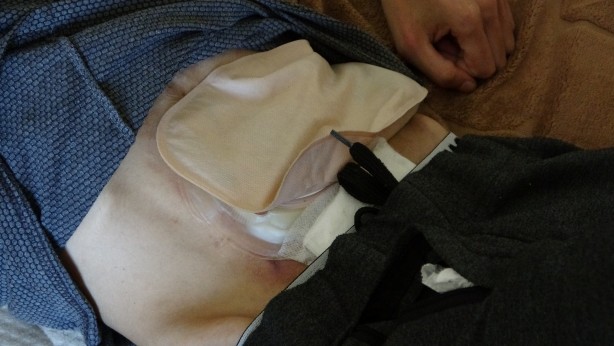 Foto - İş kazası geçirdi 40 kiloya düştü! Suriyeli Muhammed yardım bekliyor