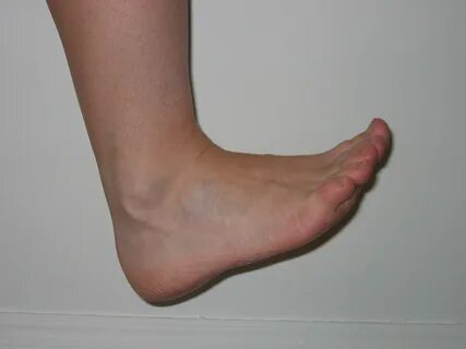 Foto - İşte ayak bileği hastalıklarının 7 belirtisi 