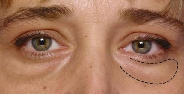 Foto - İşte böbrekleri temizleyen en etkili gıdalar