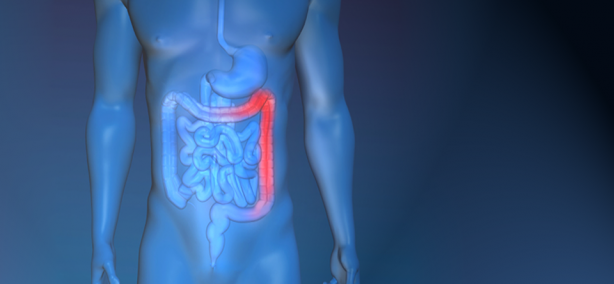 Foto - İşte kalın bağırsak kanserinin en önemli belirtisi!