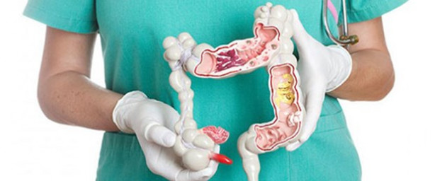 Foto - İşte kalın bağırsak kanserinin en önemli belirtisi!