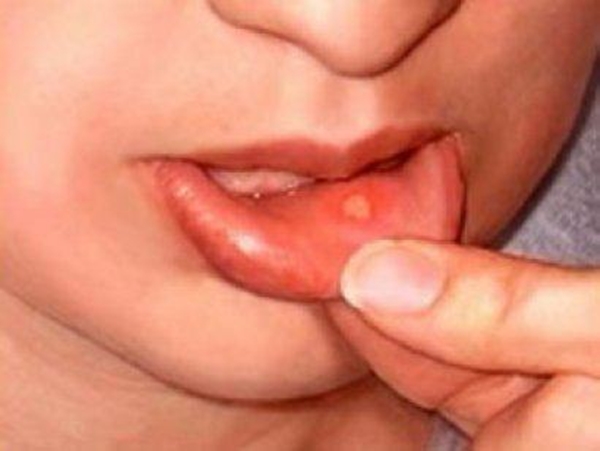 Foto - İşte kanserin belirtileri