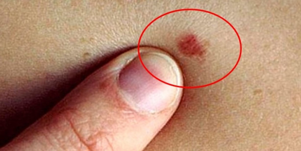 Foto - İşte kanserin belirtileri...