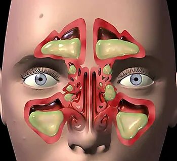 Foto - İşte sinüzite karşı 8 etkili önlem!