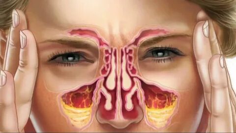 Foto - İşte sinüzite karşı 8 etkili önlem!