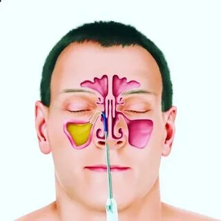 Foto - İşte sinüzite karşı 8 etkili önlem!