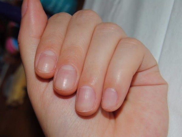 Foto - İşte tırnaklardaki beyaz lekelerin sebebi!