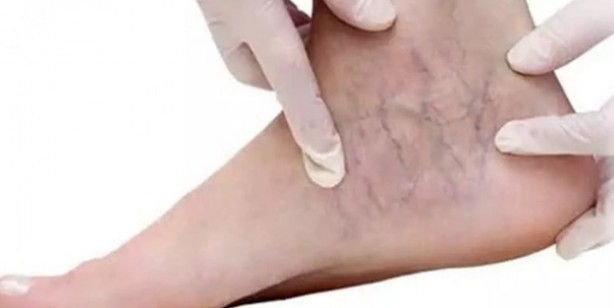 Foto - İşte varise savaş açan doğal yöntem: Evde sarımsak ile varis tedavisi