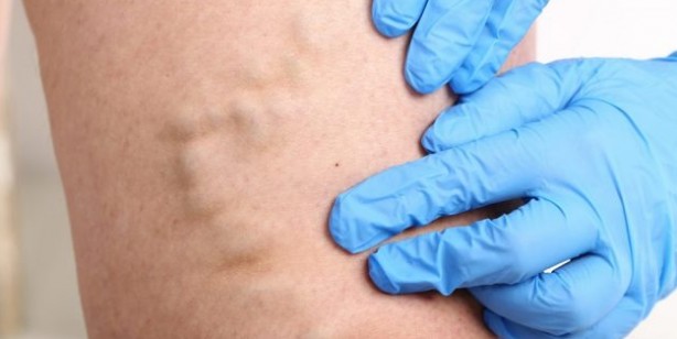 Foto - İşte varise savaş açan doğal yöntem: Evde sarımsak ile varis tedavisi