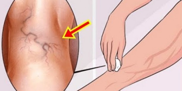  İşte varise savaş açan doğal yöntem: Evde sarımsak ile varis tedavisi