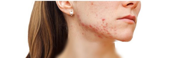 Foto - İşte yüzünüzde çıkan sivilcelerin anlamları