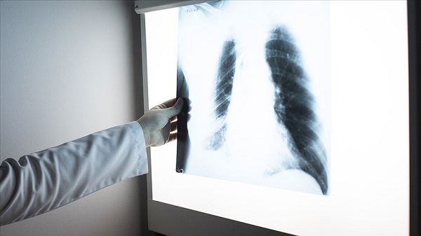 İşte, zatürre belirtileri! 