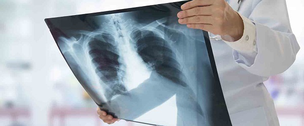 Foto - İşte, zatürre belirtileri! 