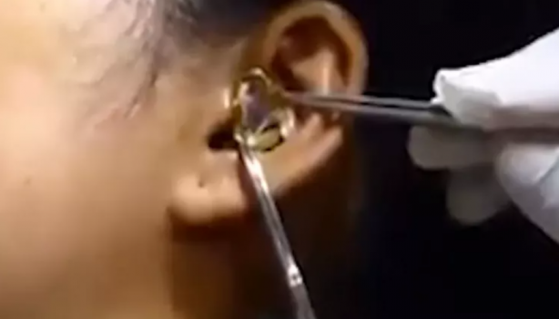 Foto - Kadının kulağına yılan kaçtı! Mide bulandıran görüntü sosyal medyayı ikiye böldü