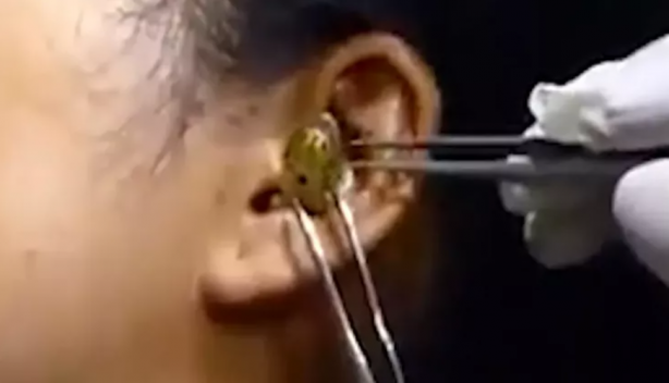 Foto - Kadının kulağına yılan kaçtı! Mide bulandıran görüntü sosyal medyayı ikiye böldü