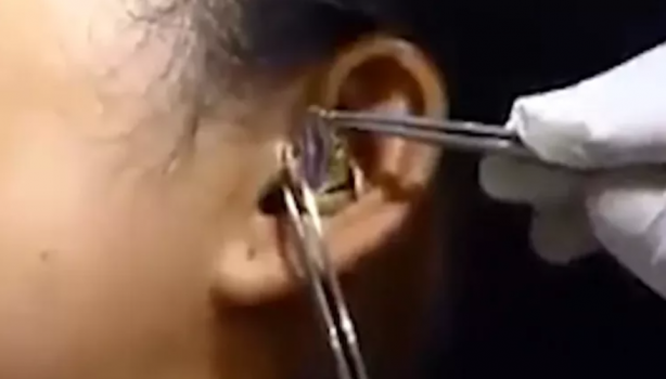 Foto - Kadının kulağına yılan kaçtı! Mide bulandıran görüntü sosyal medyayı ikiye böldü