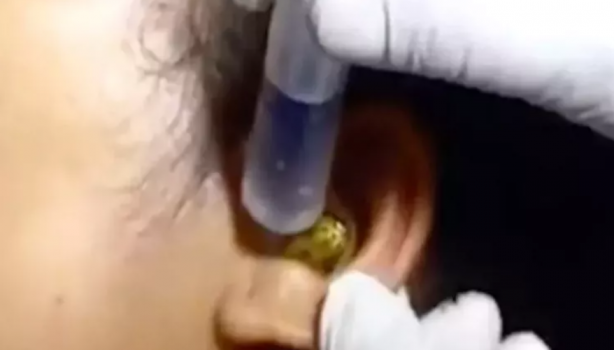 Foto - Kadının kulağına yılan kaçtı! Mide bulandıran görüntü sosyal medyayı ikiye böldü