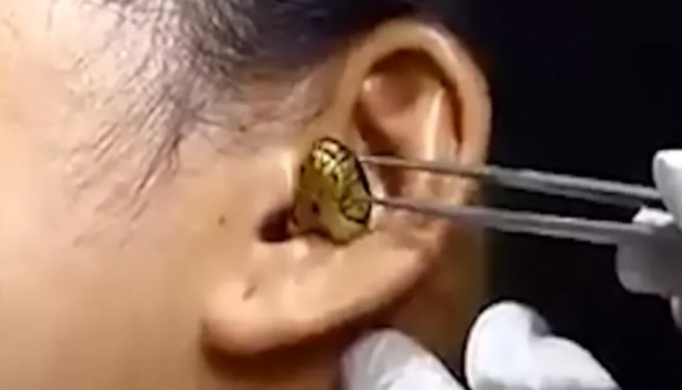 Foto - Kadının kulağına yılan kaçtı! Mide bulandıran görüntü sosyal medyayı ikiye böldü