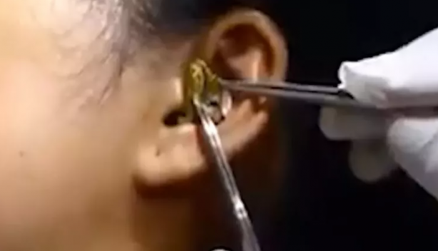 Foto - Kadının kulağına yılan kaçtı! Mide bulandıran görüntü sosyal medyayı ikiye böldü