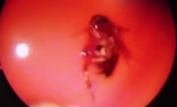 Foto - Kafatasından hamam böceği çıkarıldı!