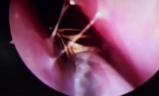 Foto - Kafatasından hamam böceği çıkarıldı!