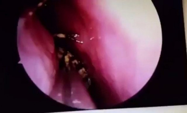  Kafatasından hamam böceği çıkarıldı!