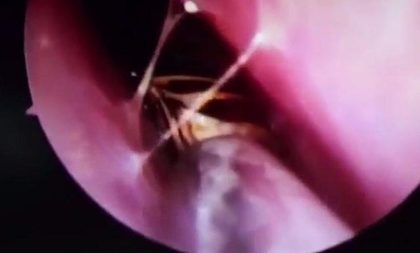 Foto - Kafatasından hamam böceği çıktı!