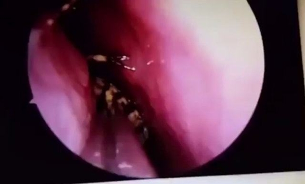  Kafatasından hamam böceği çıktı!