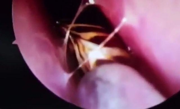 Foto - Kafatasından hamam böceği çıktı!