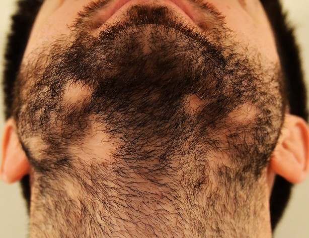 Foto - Kahveyi ıslatıp saçınıza sürerseniz bakın ne oluyor! Saç dökülmesini durdurun: Saçınızdan, sakalınızdan saç fışkıracak