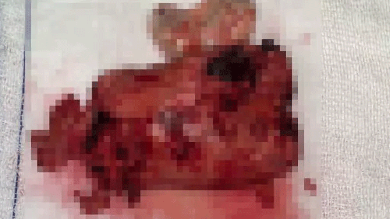 Foto - Doktorlar kalbinden çıkardı! Ağırlığı neredeyse kalp kadar!