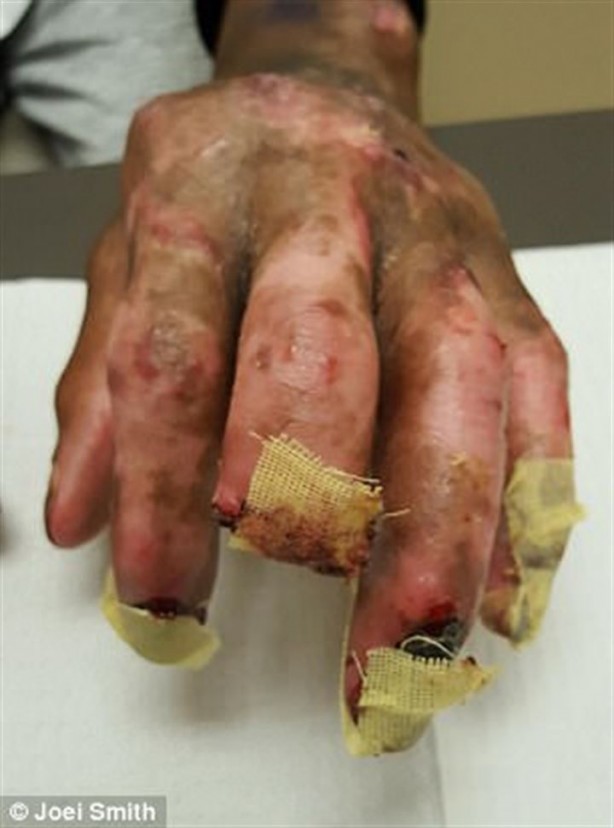 Foto - Kalp çarpıntısı şikayetiyle acile gitti, parmaklarını kestiler!