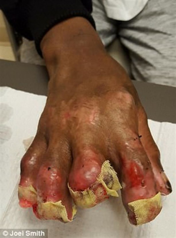 Foto - Kalp çarpıntısı şikayetiyle acile gitti, parmaklarını kestiler!