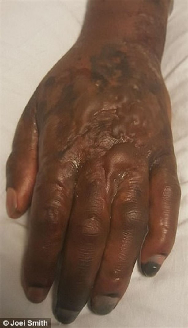 Foto - Kalp çarpıntısı şikayetiyle acile gitti, parmaklarını kestiler!