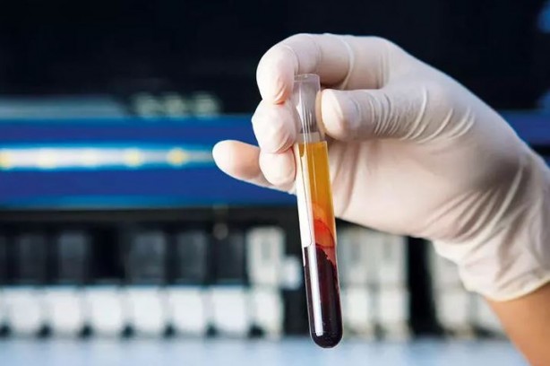 Foto - Kan testiyle kanseri tespit ettiler