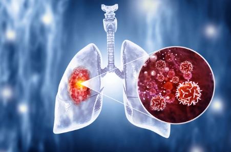 Foto - Kanser yaşı düşüyor! Uzmanlar nedenini açıkladı