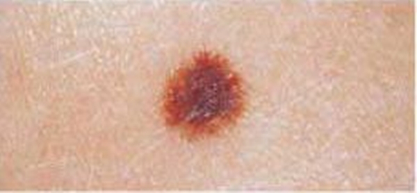 Foto - Kanserli ben nasıl anlaşılabilir?