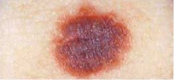 Foto - Kanserli ben nasıl anlaşılabilir?