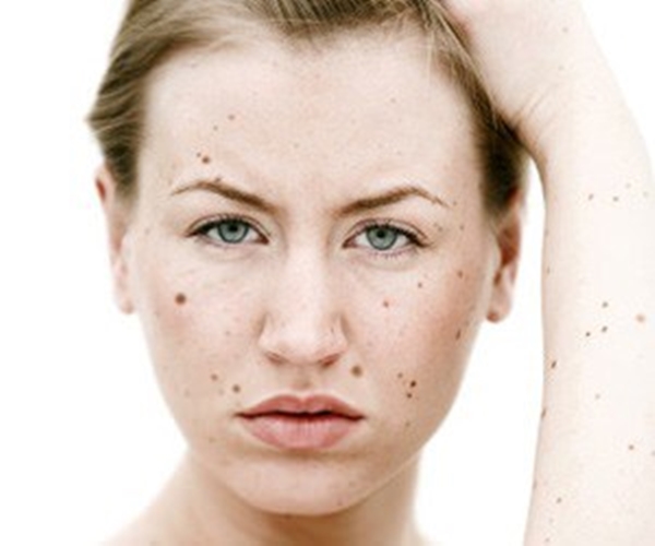 Foto - Kanserli ben nasıl anlaşılabilir?