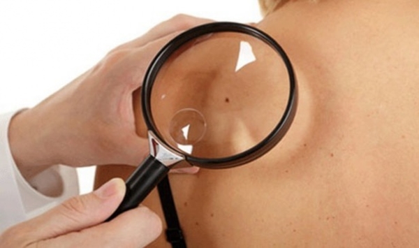  Kanserli ben nasıl anlaşılabilir?