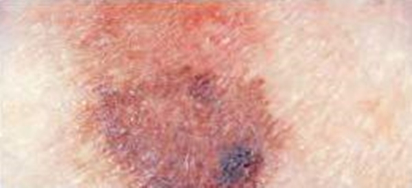 Foto - Kanserli ben nasıl anlaşılabilir?