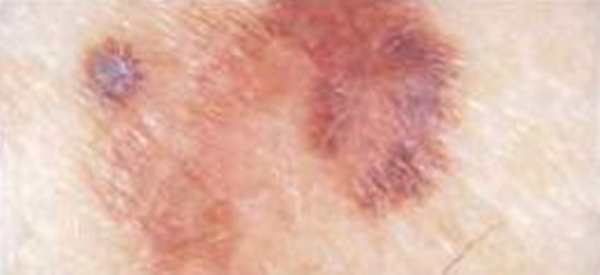 Foto - Kanserli ben nasıl anlaşılabilir?